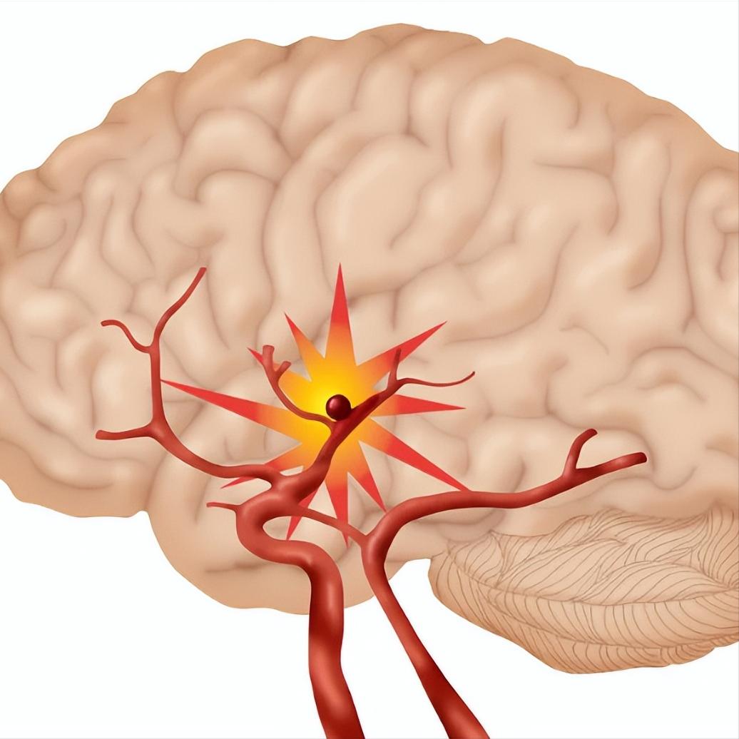 脑出血发生在哪个部位是最危险的？一文给你说清楚

很多人以为脑出血都一样，其实大