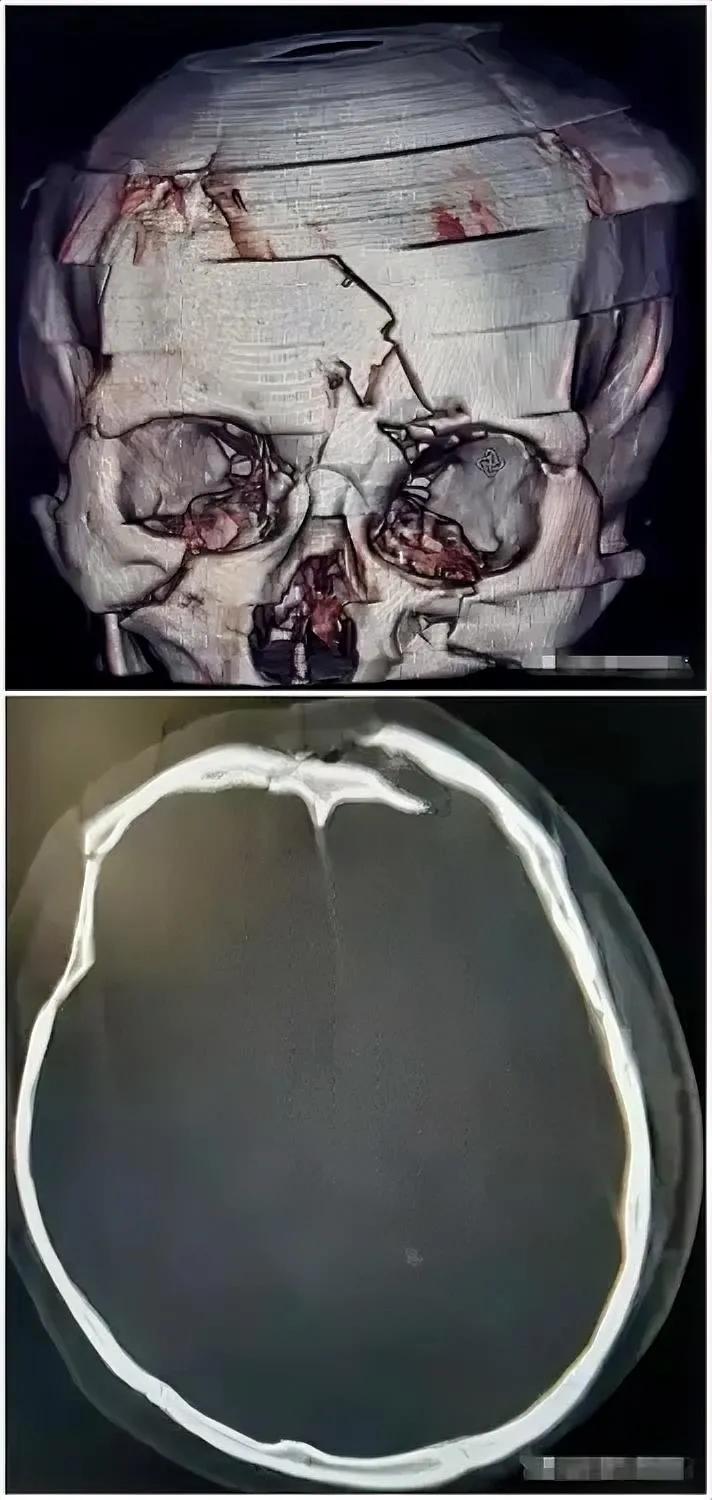 外伤！[发怒]
重型颅脑损伤！

去医院拍头CT，您知道平扫和三维的区别吗？
