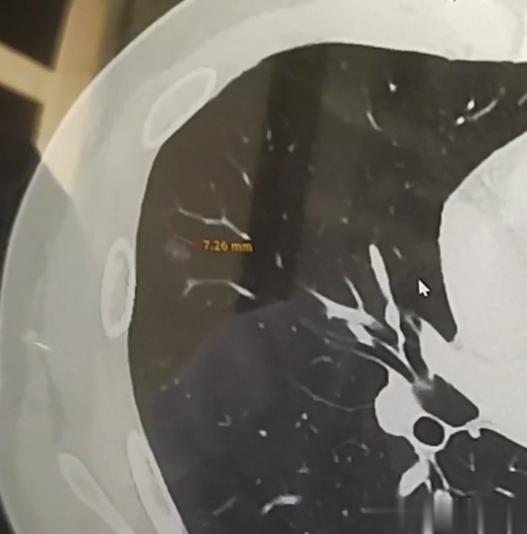 肺小结节担心手术要切肺，随访又担心突然进展，听说：“消融”能不开刀，解决掉肺结节