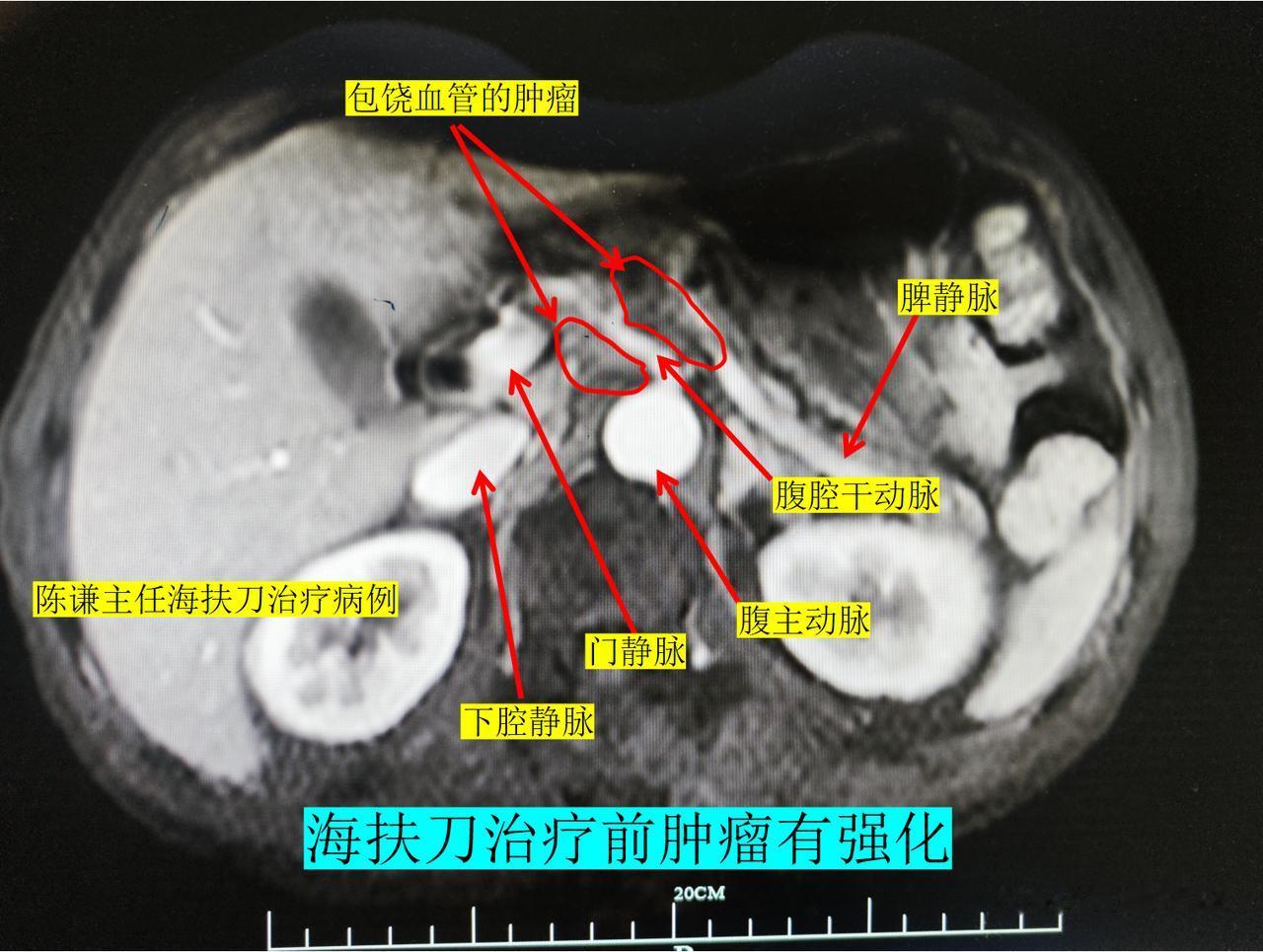 胰腺癌包绕血管不能手术怎么办?目前对于包绕血管胰腺癌，治疗方案也挺多，主要有以下