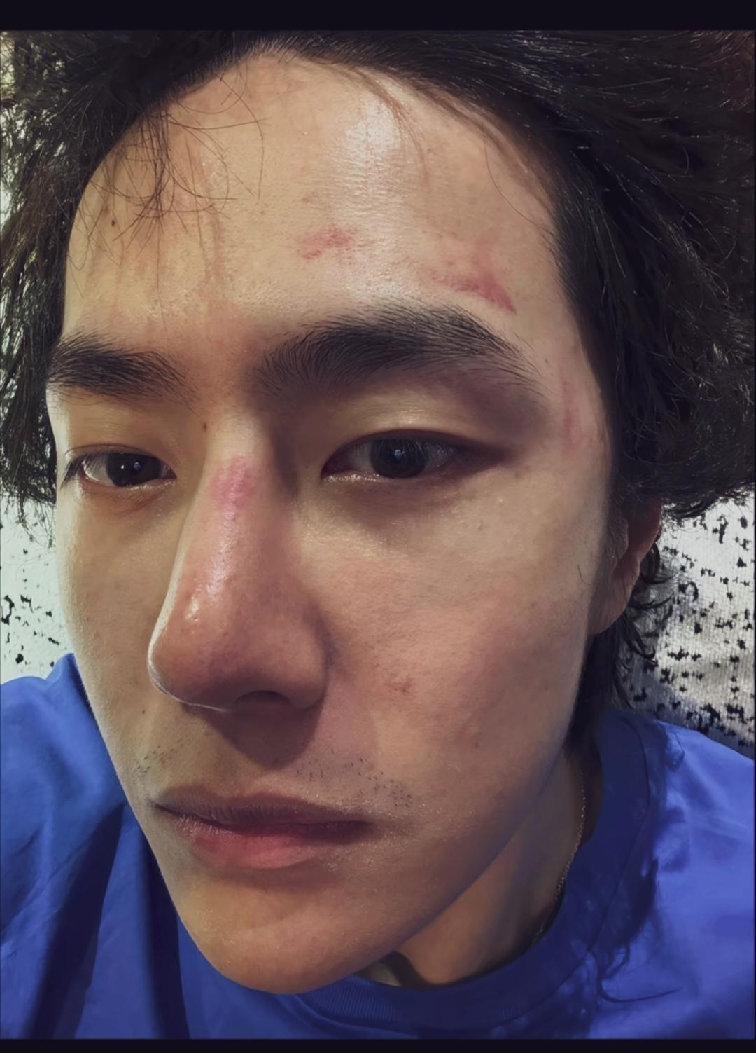 王一博自拍照，看着脸是怎么了？是过敏了？还是受伤了？