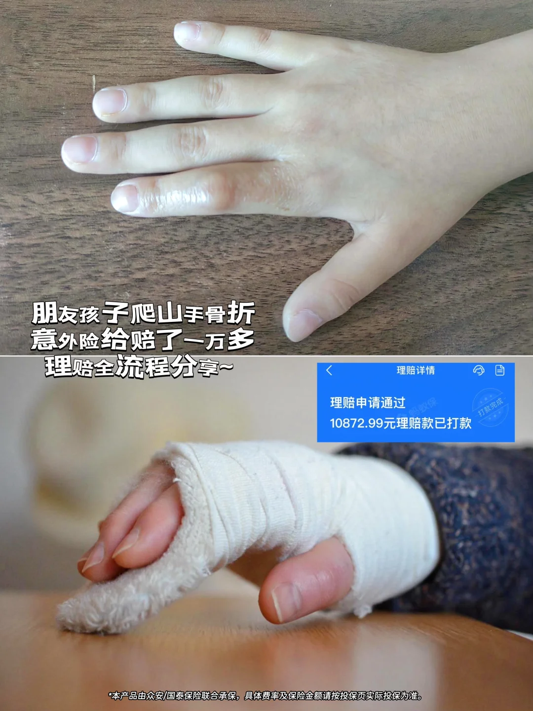 朋友娃爬山骨折花一万，意外险3天全赔回来了