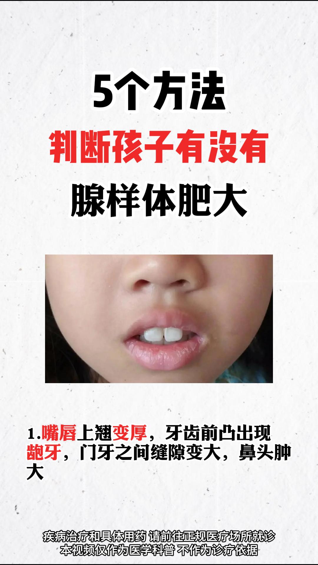 5个方法 判断孩子有没有 腺样体肥大。