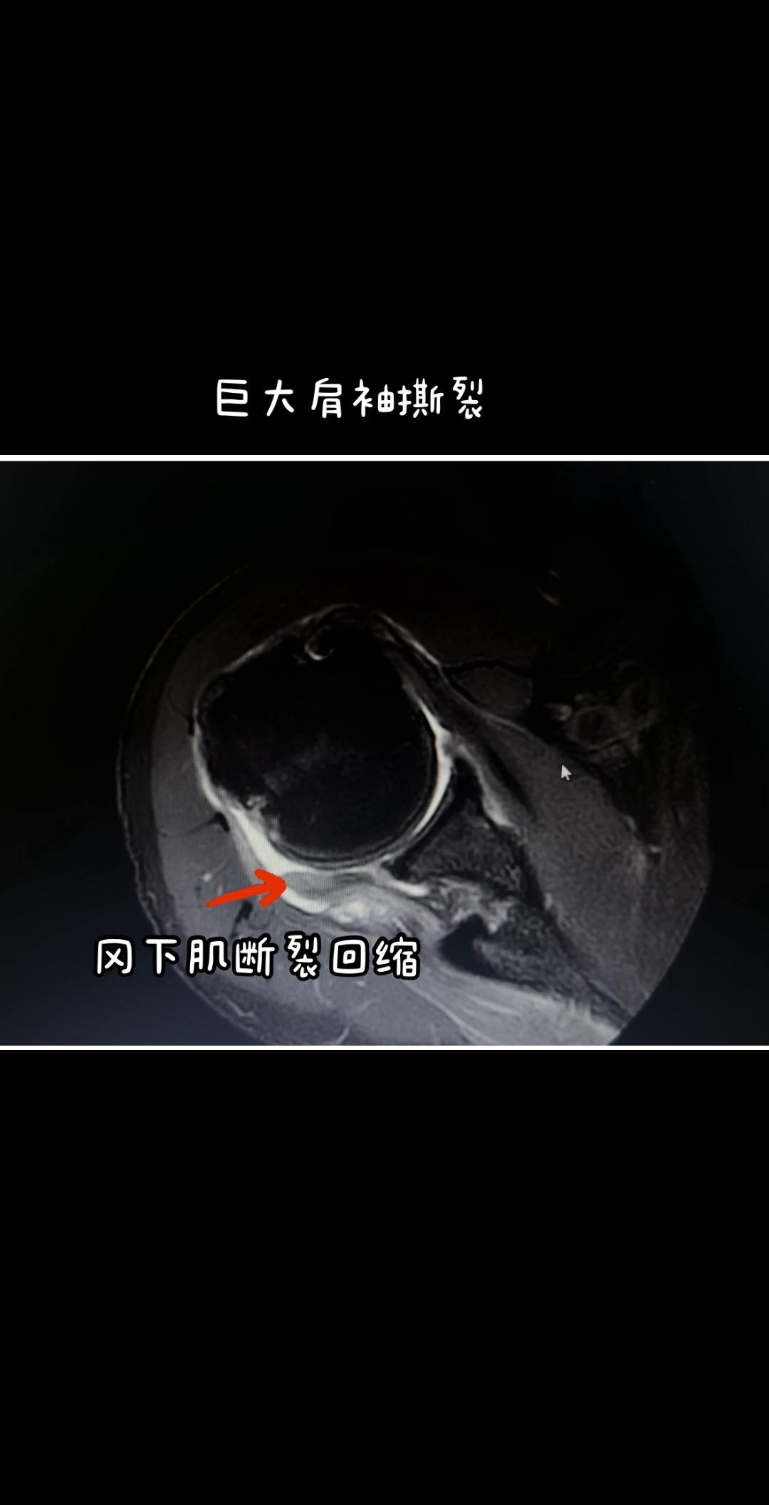 巨大肩袖无法修复怎么办。自体阔筋膜张肌重建上关节囊技术