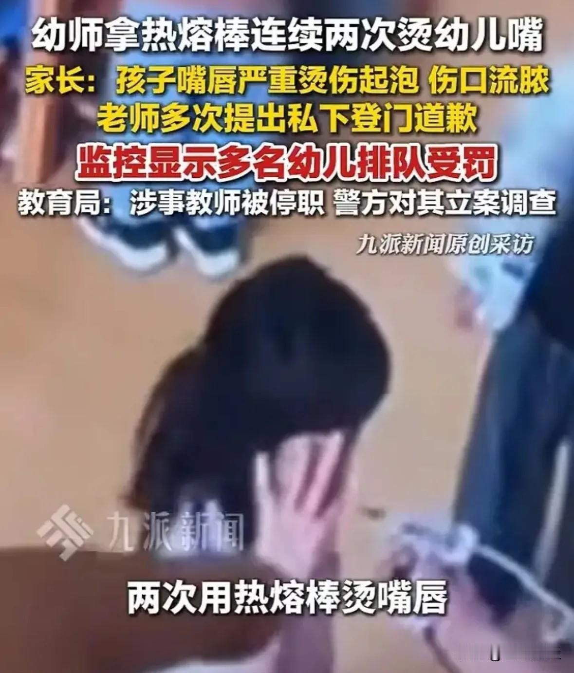 徐州幼师烫伤幼童这件事，真的越看越让人愤怒！孩子娇嫩的嘴巴被热熔胶烫到溃烂，遭了