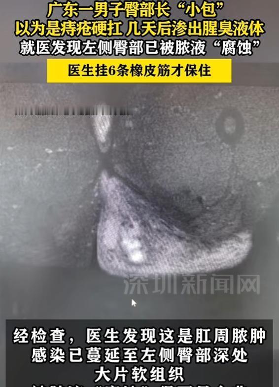 东莞陈先生屁股上长了个小硬块，以为是应酬多上火犯了痔疮，疼到冒冷汗也硬扛，结果左