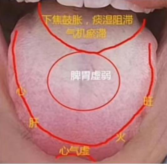 这种舌头，若不按顺序来调理，可谓是难上加难！火邪，湿邪，血瘀全占了！
患者主诉：