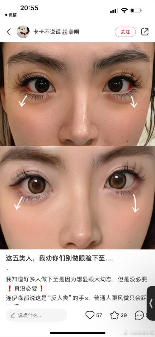 虽然但是，我没做过下至我是天生下睑缘松弛…我也没刻意幼态 我只做过了双眼皮➕上眼