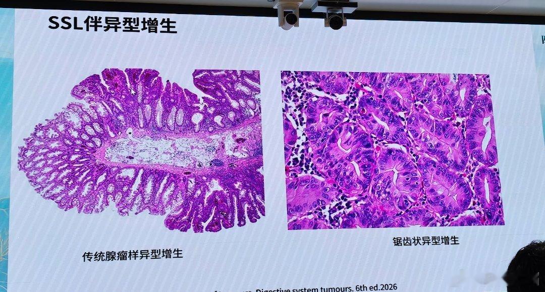 SSL伴异型增生病理切片解读（WHO消化道肿瘤第6版2026标准）一、基础名词释