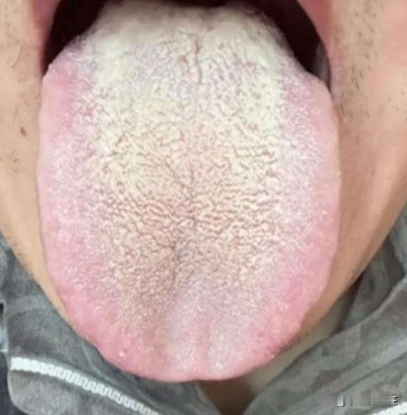 今天碰到一位患者，他的舌象阳虚和寒湿极重！
自述：手脚总是冰凉，还特别怕冷，但奇