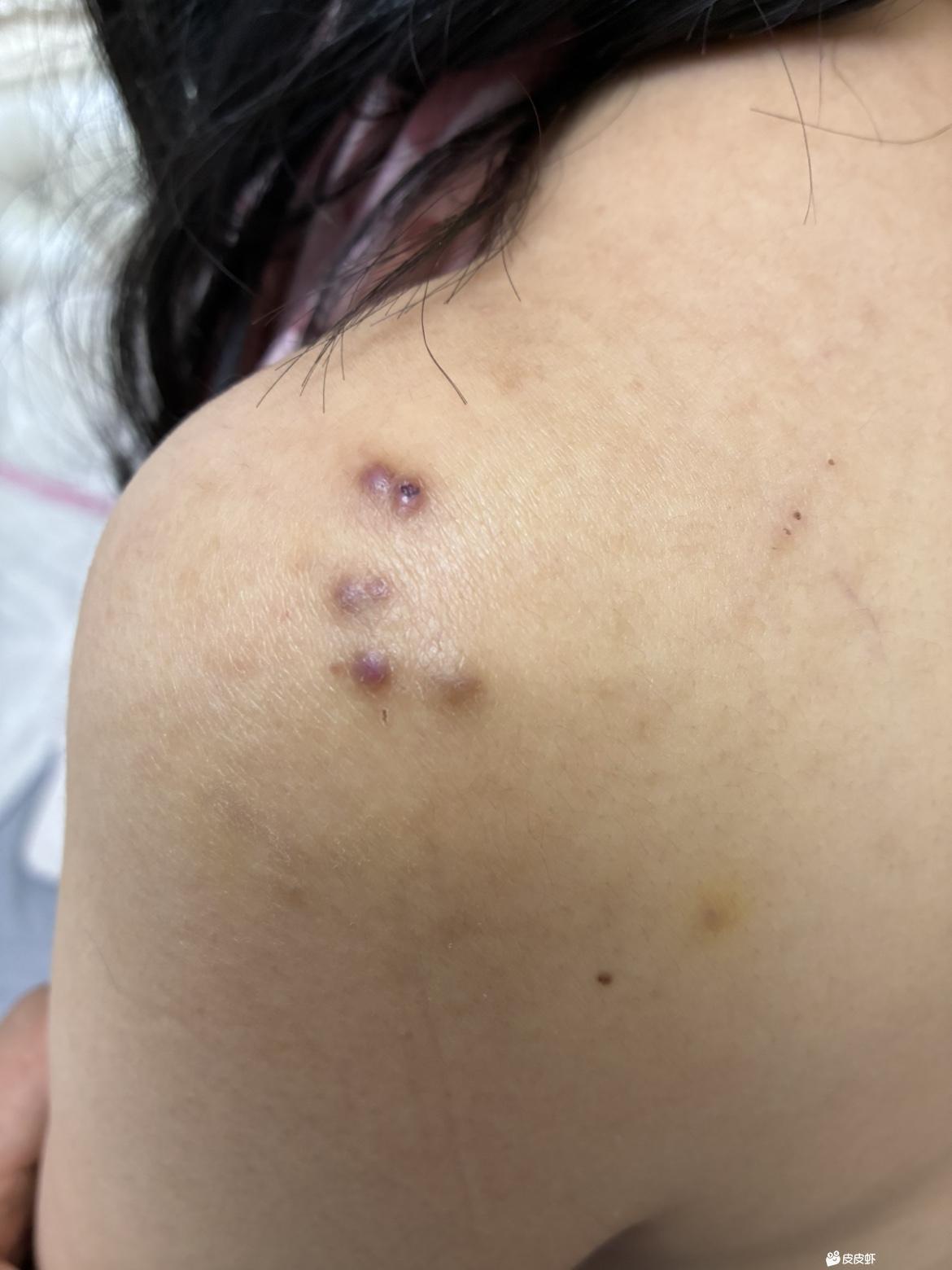 我老婆身上长的这些东西是什么呀？
她说是痘痘，30多岁的年纪还会长痘痘吗？
最近