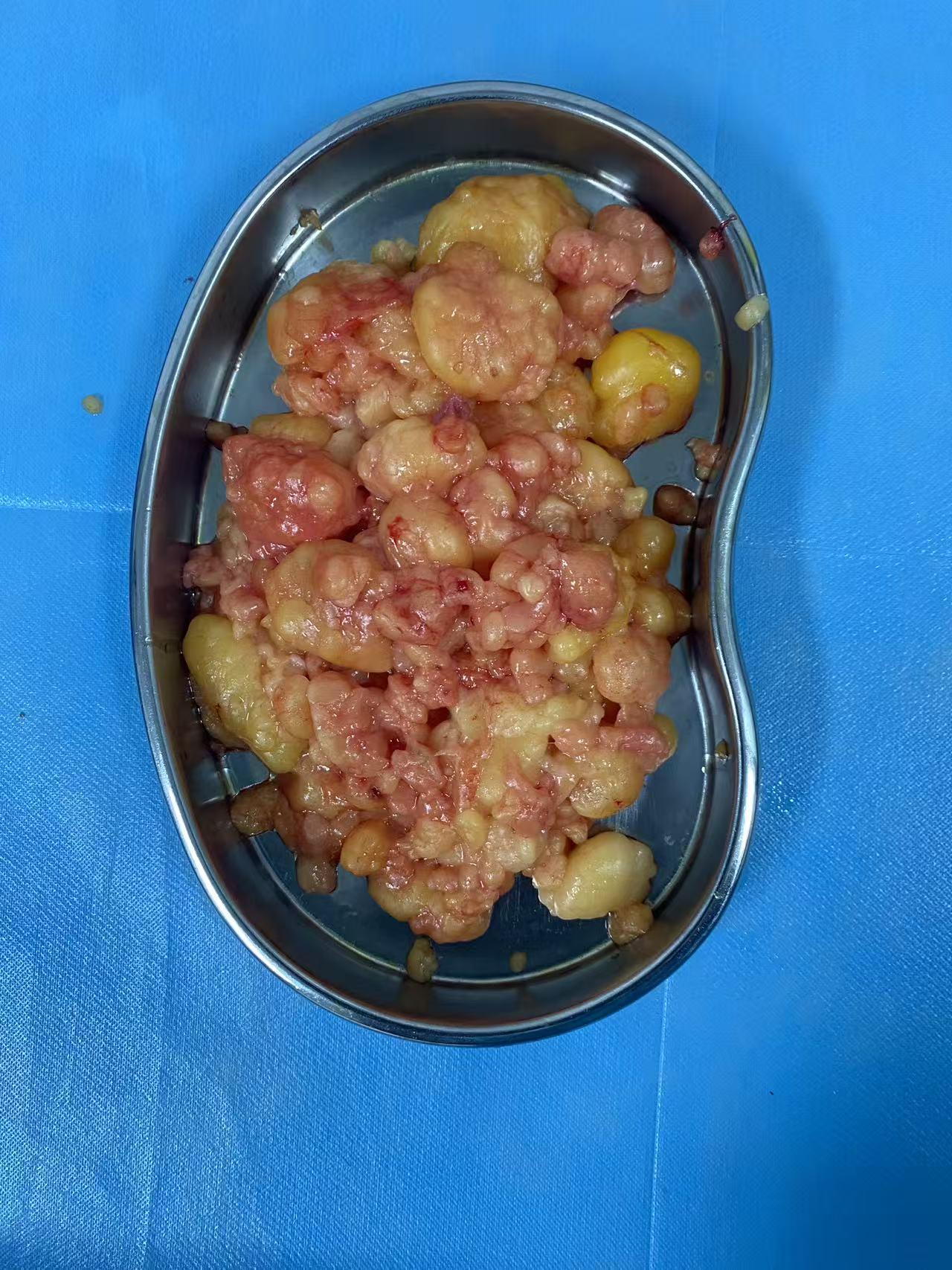 普通手术解决了困扰自己几十年的脂肪瘤问题，做了五个多小时，受了老鼻子罪，唉，据说