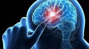 脑卒中（Stroke）即俗称的中风。中风这个词来自中医，当然不是老百姓传说的让风