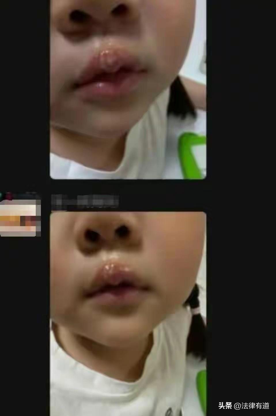 如此虐待幼童，哪里是老师，简直是恶魔！幼儿园老师用烧融的热熔胶棒烫孩子嘴巴，导致