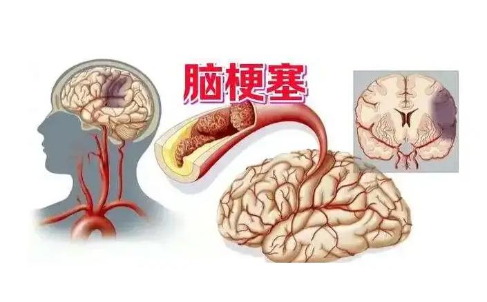 为什么现在脑梗越来越多？医生提醒：饭后少做3件事，劝你改正


随着现代生活节奏