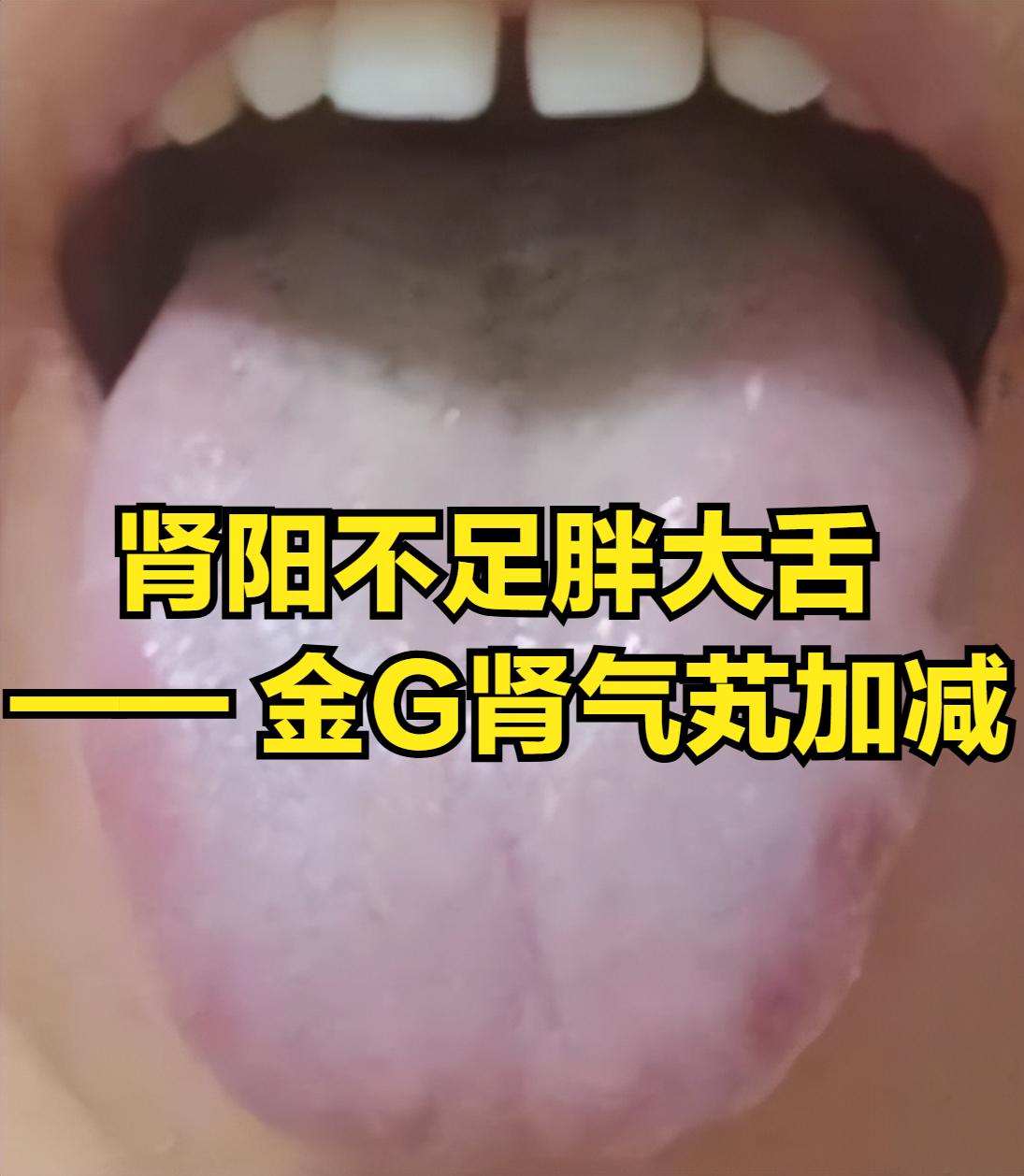肾阳不足证（胖大舌）的舌象解析及金匮肾气丸加减调理
中医认为“肾主水液，司气化，