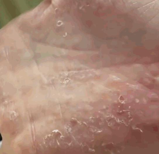 “太可怕了！”河南这位女子的遭遇可不是什么罕见的怪事，但凡手上长过那种密密麻麻小