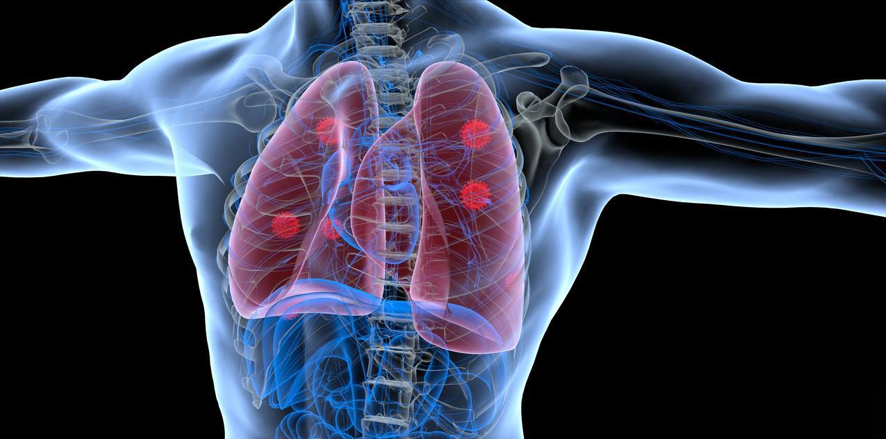 什么人更容易患肺癌？五种人尤其要当心，定期体检早期发现很重要
肺癌的发病是遗传与