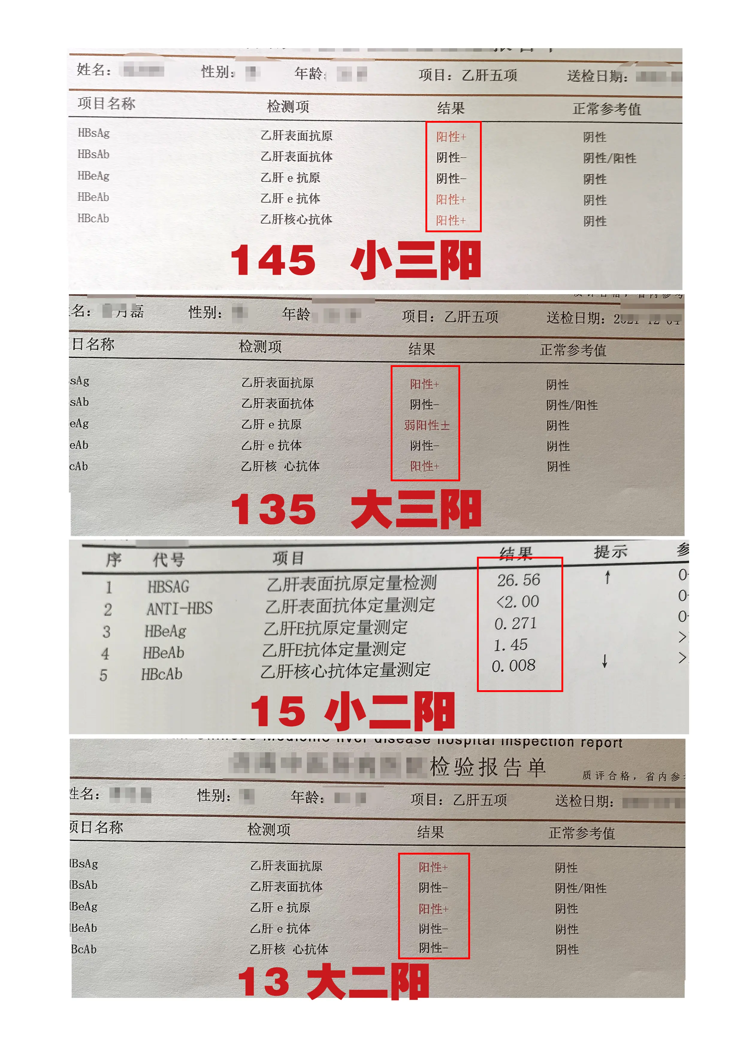 乙肝五项定性怎么看？ 乙肝表面抗原阳性，可能感染了乙肝病毒。乙肝表面抗...