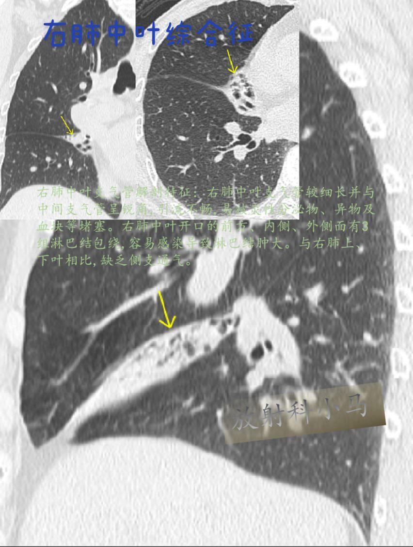 右肺中叶综合征是指不同病因所致右肺中叶孤立性肺不张或充气不全的一种临床...