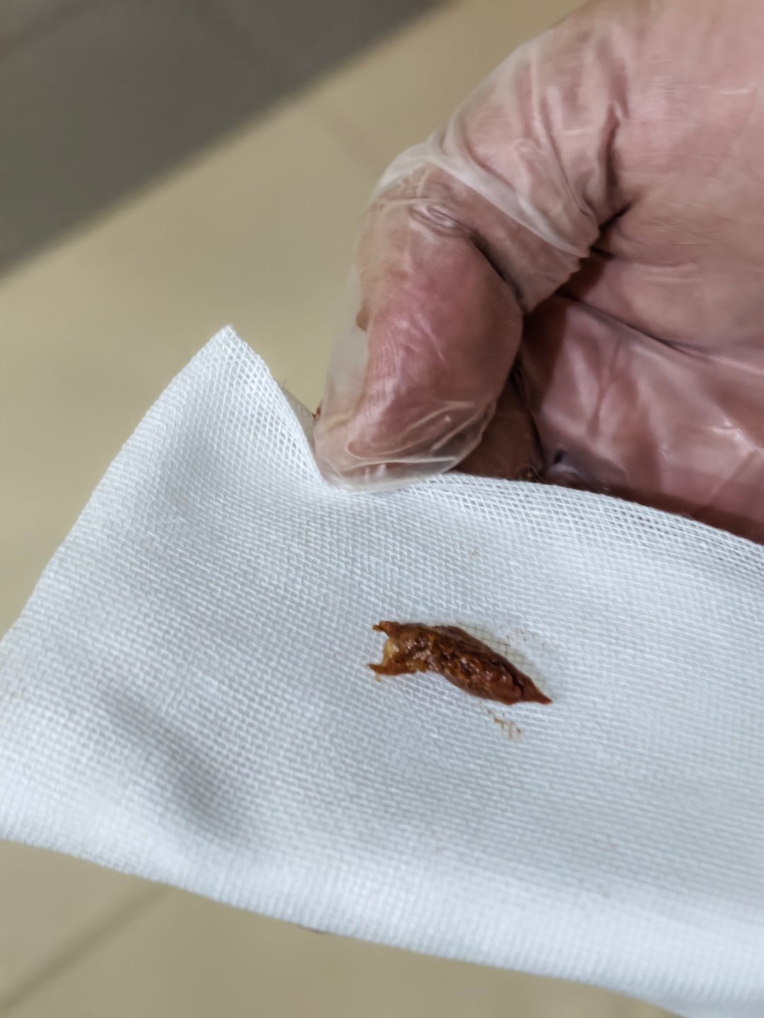 罪魁祸首——枣核，取出来了但是医生说食道里有个泡距离气道口太近（大概这么个意思）