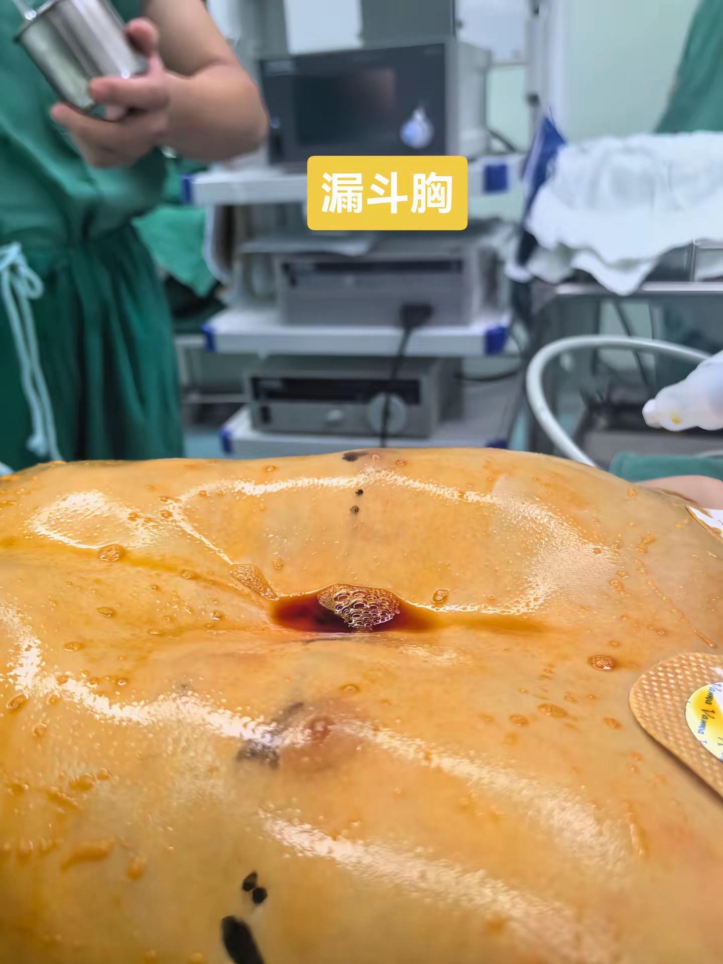 漏斗胸。漏斗胸，又称“凹陷胸”，是一种常见的胸廓发育畸形。其主要表现为...