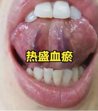 热盛血瘀、气滞血瘀、寒凝血瘀、气虚血瘀？从舌象看健康，精准调理秘籍大公开！
1、