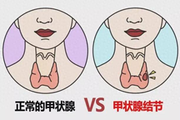 甲状腺结节别乱切！1 味散结 “王炸”，破瘀、消肿、散痰块，稳住结节不长大
我是