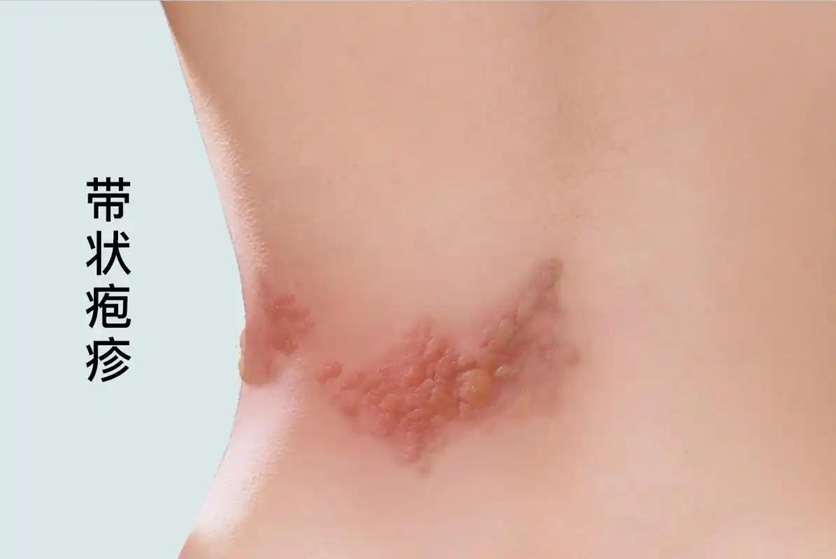 免疫力差=带状疱疹高危人群？医生提醒，这5个习惯最伤免疫

免疫差，就等着中招？
