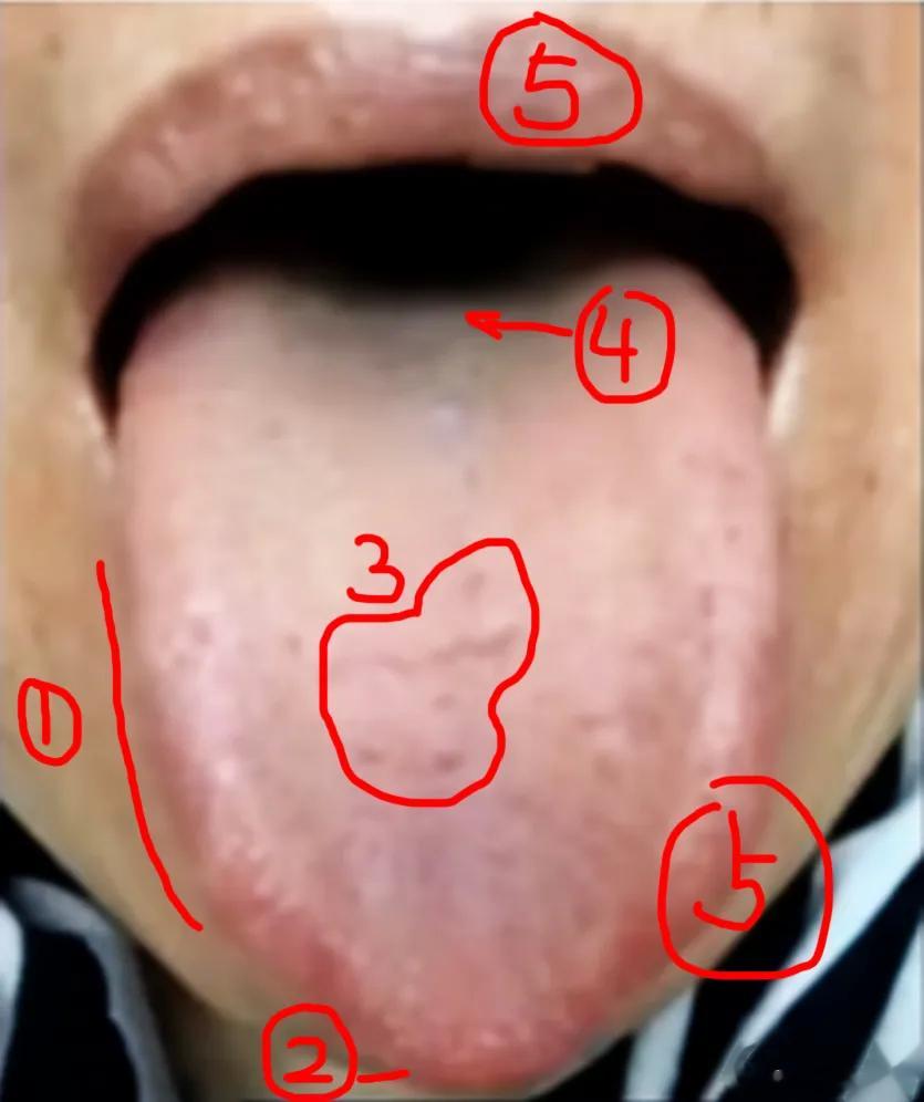 【粉丝舌象分析：肝旺克脾，生心火，中医教你一招摆平】女，39岁，症状：失眠多梦，