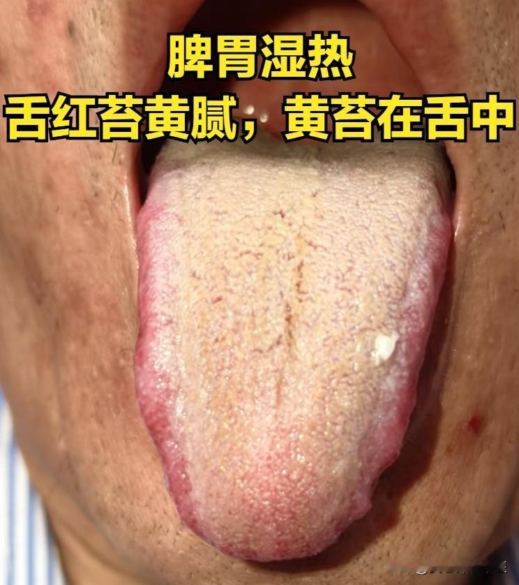 湿热 同样是黄舌苔，用药却完全不一样，中医教你辨证论治

1、脾胃湿热
辩证：脾
