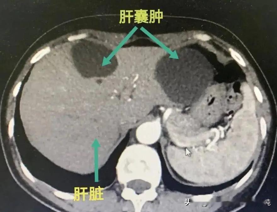 肝囊肿患者，不要总做这4件事，对病情没好处！
大家好，我是中医刘博纯！
肝囊肿虽