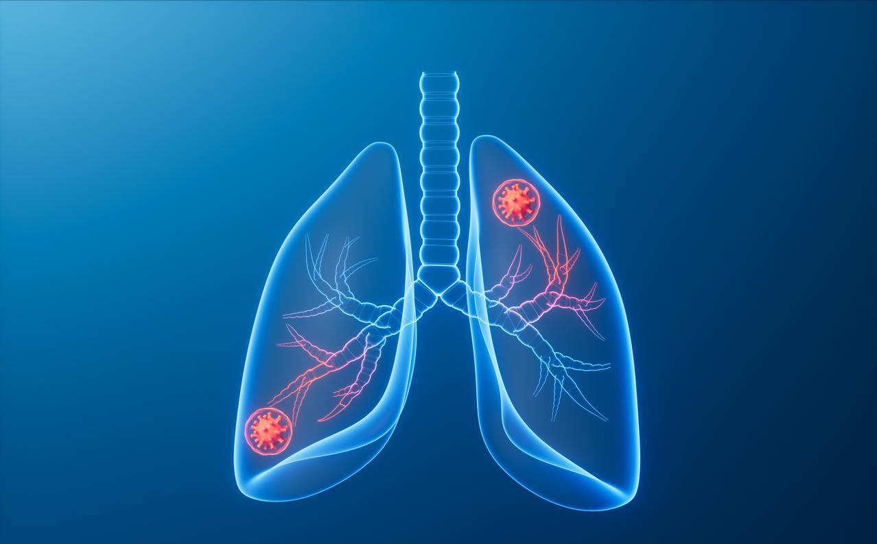 肺癌结节只有8mm就转移到了胸膜失去了根治机会，虽然很少见，但的确存在
结节长在