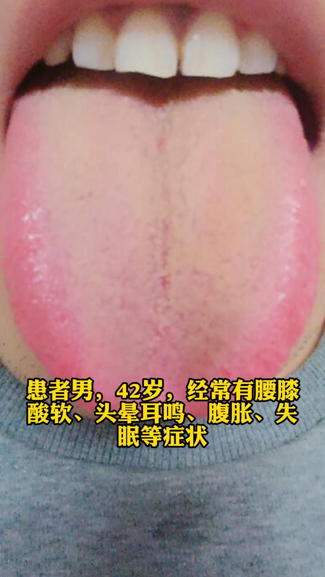 患者舌苔发黄，苔少，这反映了体内存在热邪，尤其是脾胃湿热。黄色舌苔通常与胃火亢盛或肝胆湿热有关，苔少则可能表示胃气虚弱，湿热伤阴。
腰膝酸软、头晕耳鸣，这些症状是肾虚的典型表现。肾主骨生髓，肾精不足则腰膝酸软；肾开窍于耳，肾虚则耳鸣；肾精不能上荣于脑，则头晕。
腹胀则与脾胃功能失调有关，脾胃湿热阻滞气机，运化失常，导致腹胀。
失眠则可能由心肾不交、心神不宁所致。肾水不足，不能上济心火，心火亢盛，扰动心神，导致失眠。
 
从中医角度看，这些症状主要源于肾阴不足、脾胃湿热以及心肾不交。肾阴不足，则腰膝酸软、头晕
