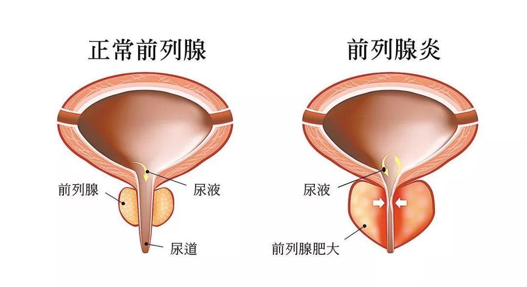 前列腺炎常见症状及病因尿频尿急：湿热内蕴尿滴白：寒湿下注小便浑浊：湿气重小腹坠胀