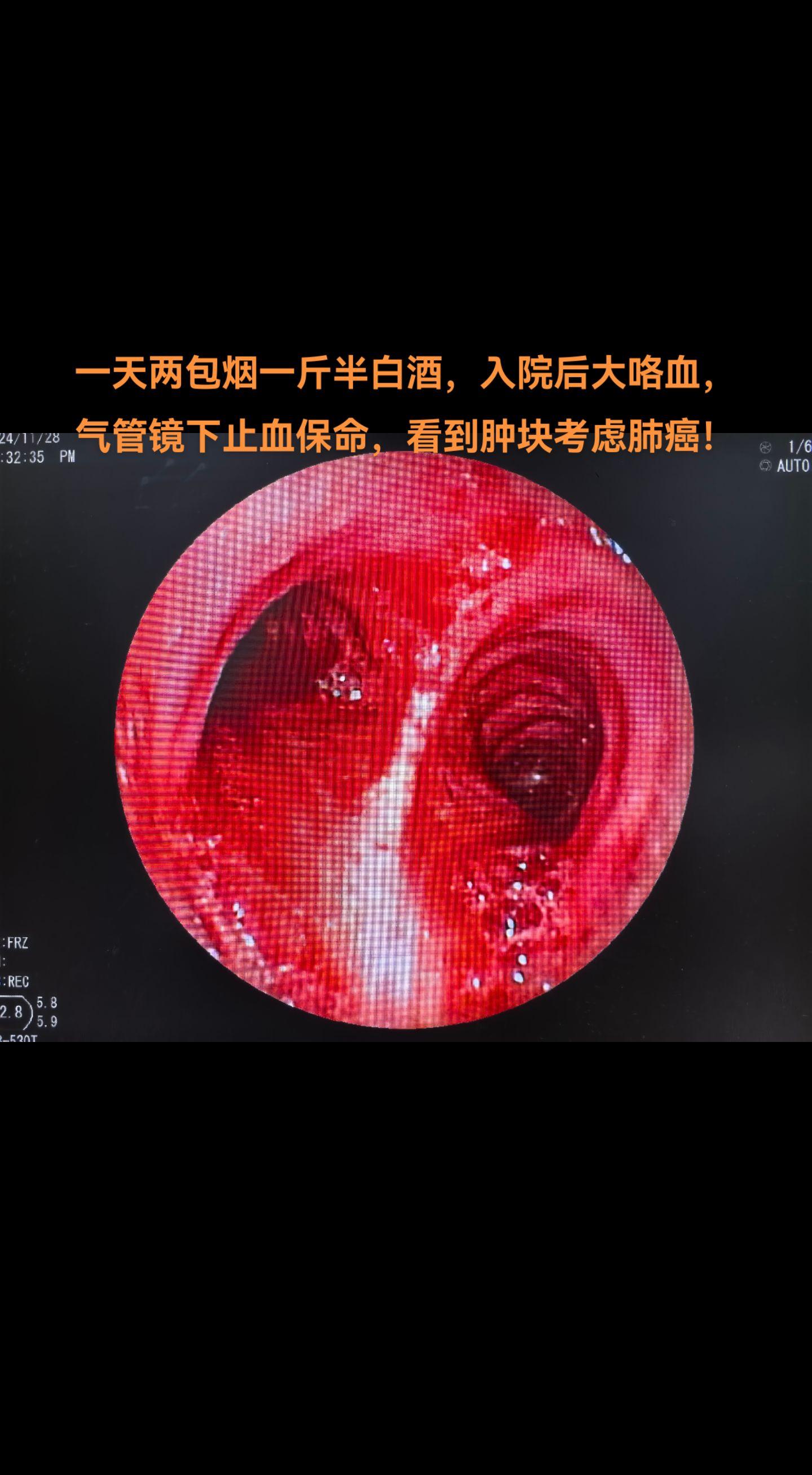 大咯血镜下止血，诊断考虑肺癌出血。