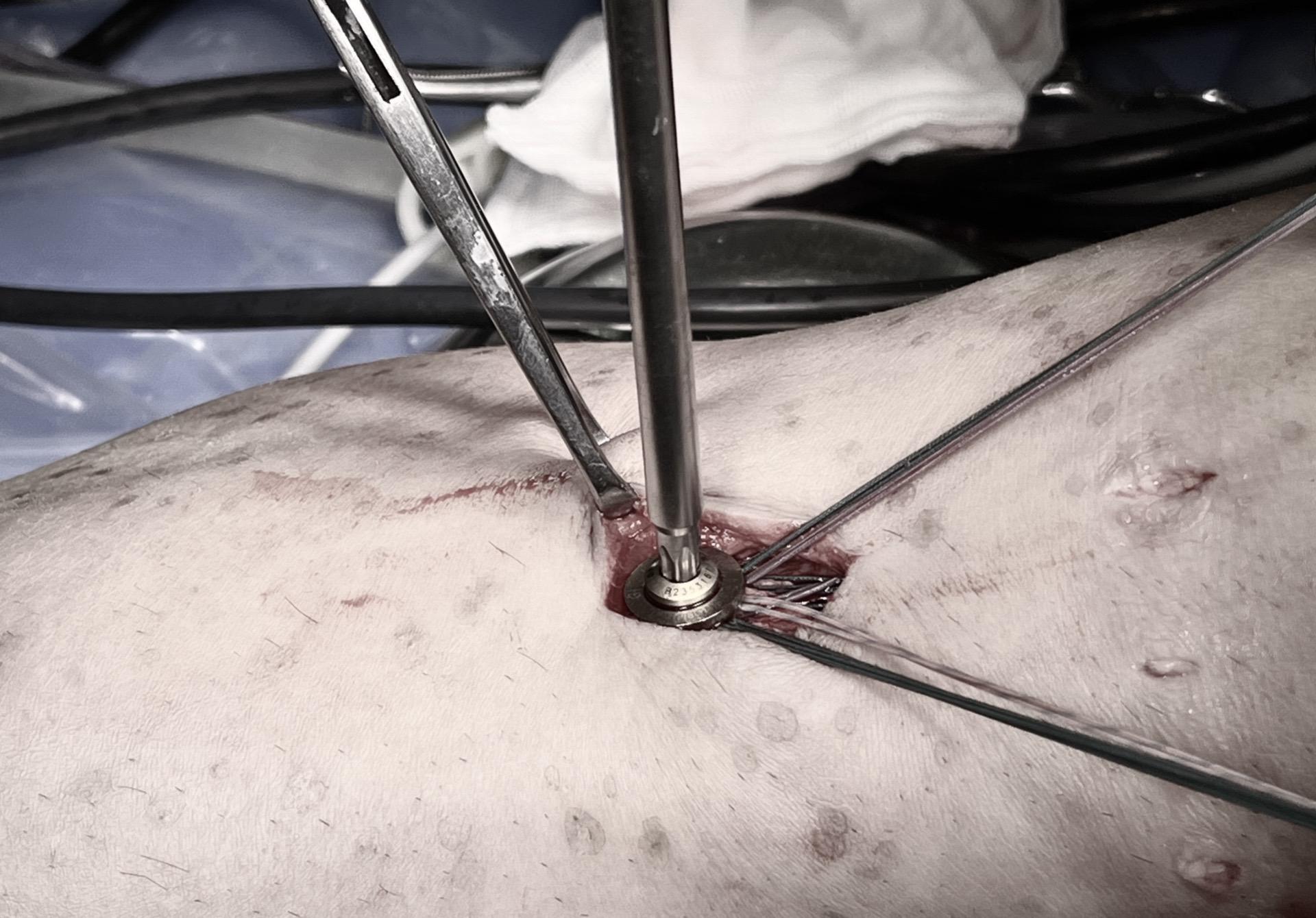 前交叉韧带重建术。取腘绳肌，单束8股重建。