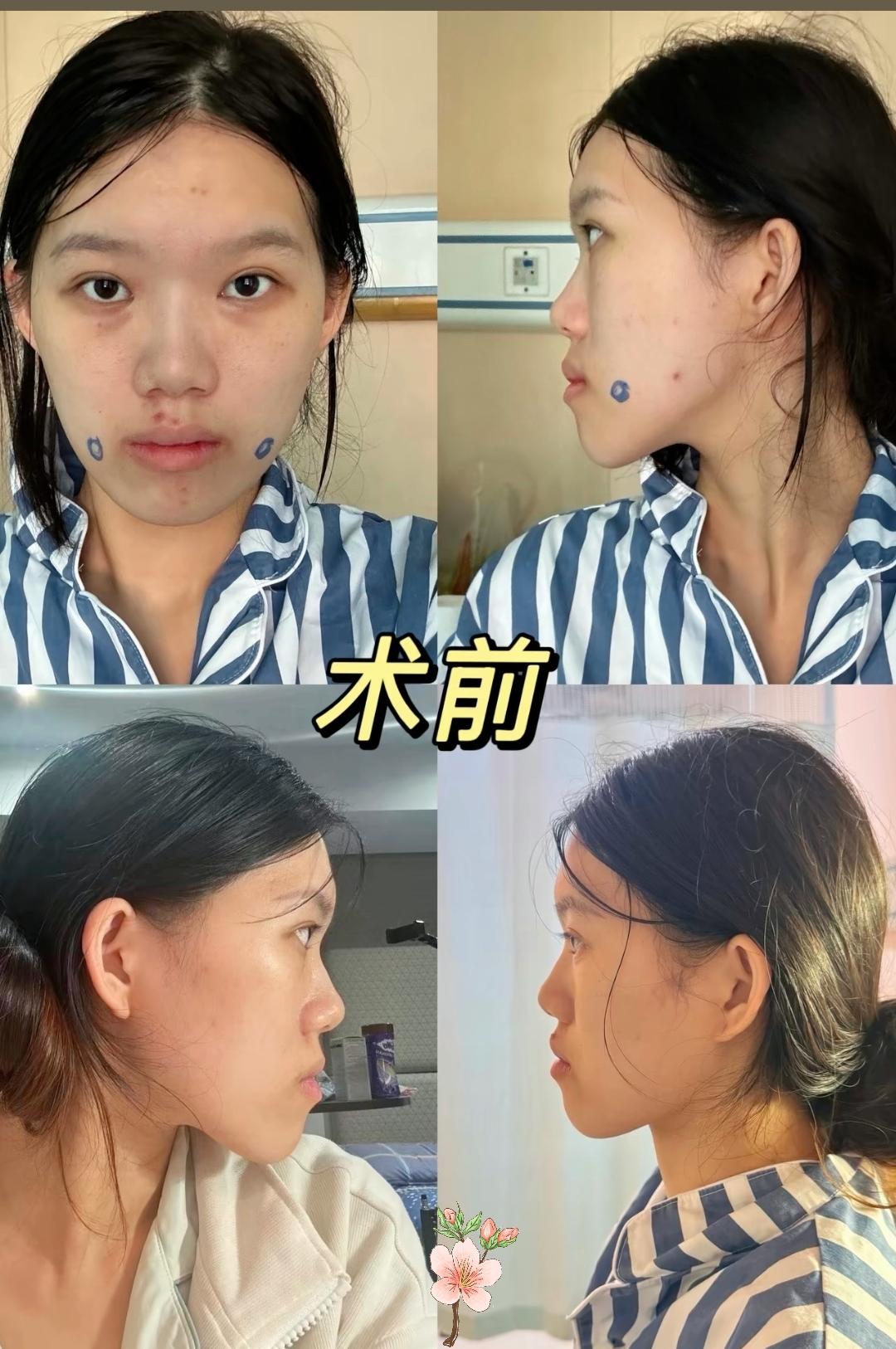 一句“现在的面型比之前更洋气”，直接把我看破防了！
武汉小雨去武大口腔看牙，原本