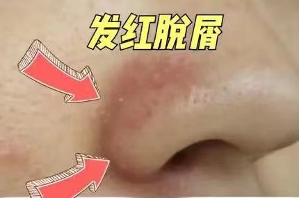 #鼻翼常年泛红这是皮肤病#鼻翼两侧的沟沟常年泛红，时轻时重。扒开仔细看看，还爬满