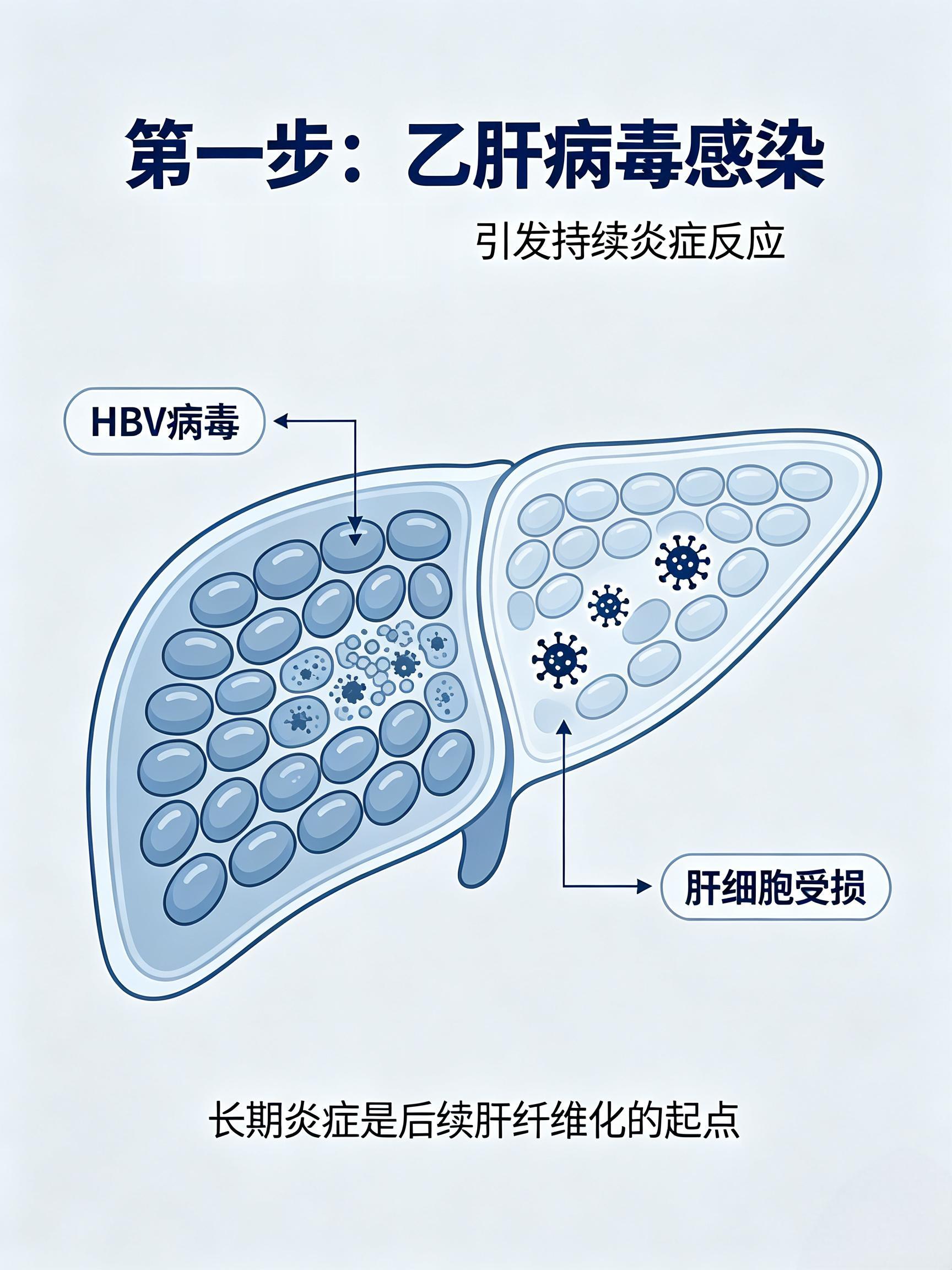 从乙肝—肝硬化—肝癌，你的肝脏究竟经历了什么
