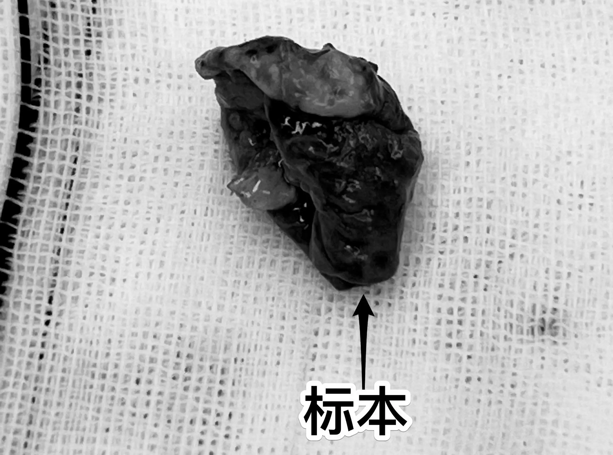 鞍隔下型颅咽管瘤经翼点入路切除合适吗？13岁的山东省菏泽市男孩子，九年...