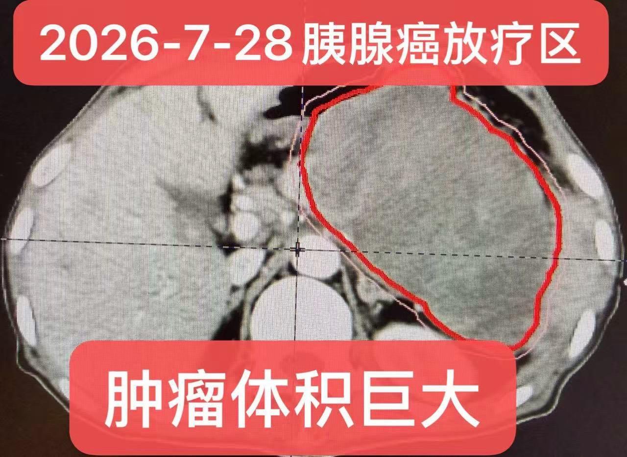 体积巨大的晚期胰腺癌的治疗。患者：男，38岁，病理：胰腺差分化癌（PD...