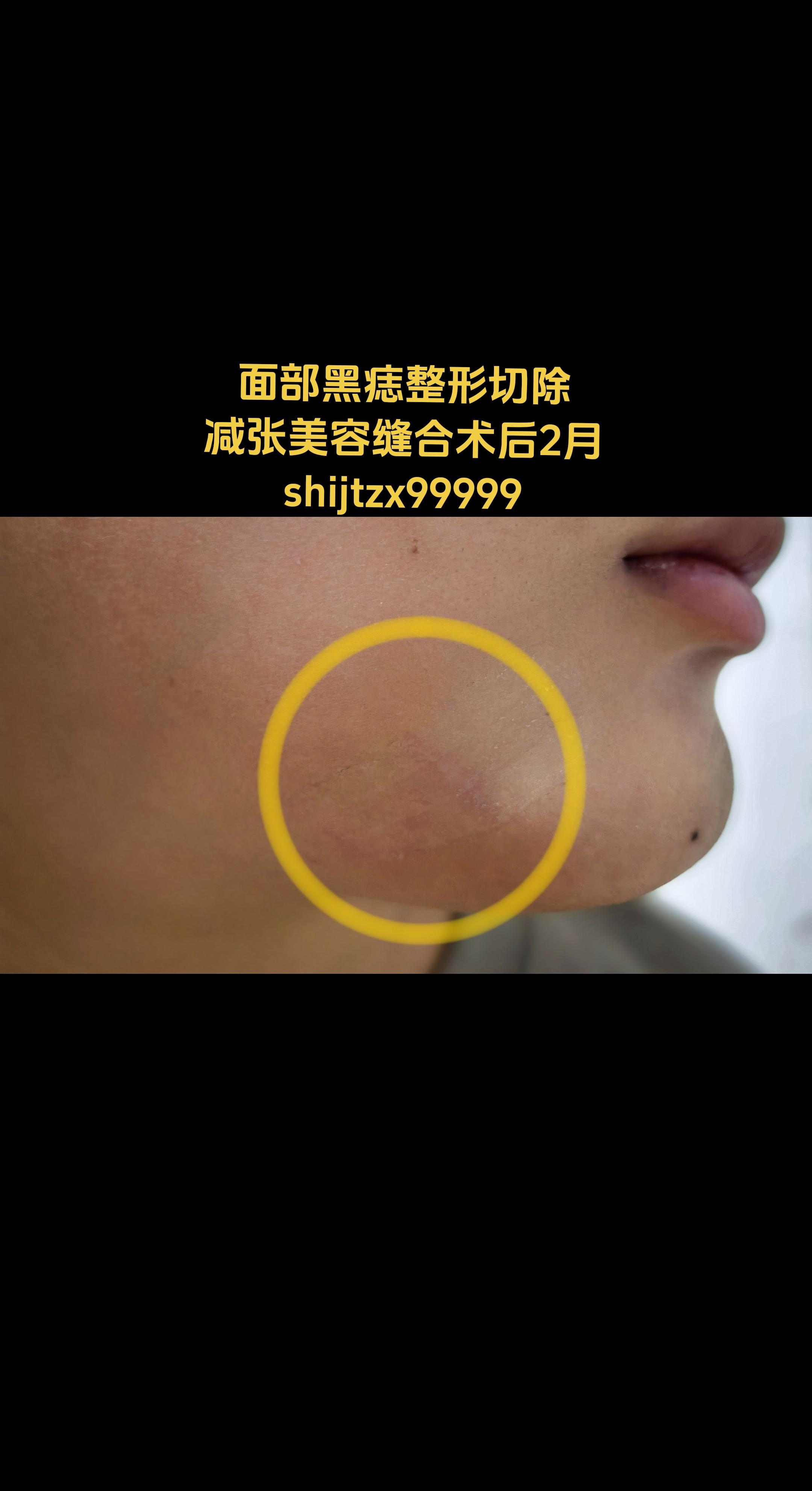 面部黑痣。面部黑痣整形切除，减张美容缝合，术后抹抗疤药膏贴减张贴护理...
