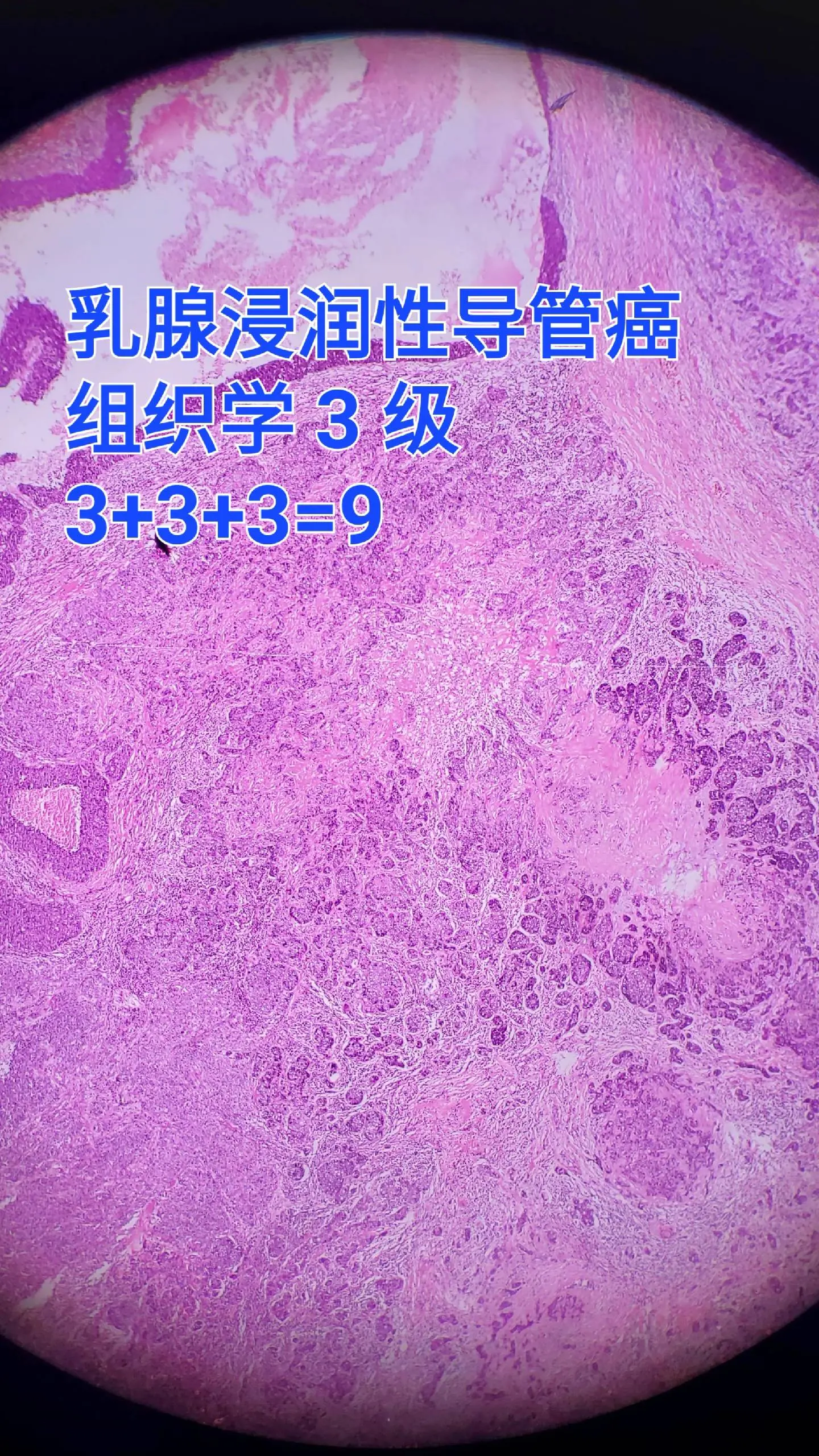 乳腺癌