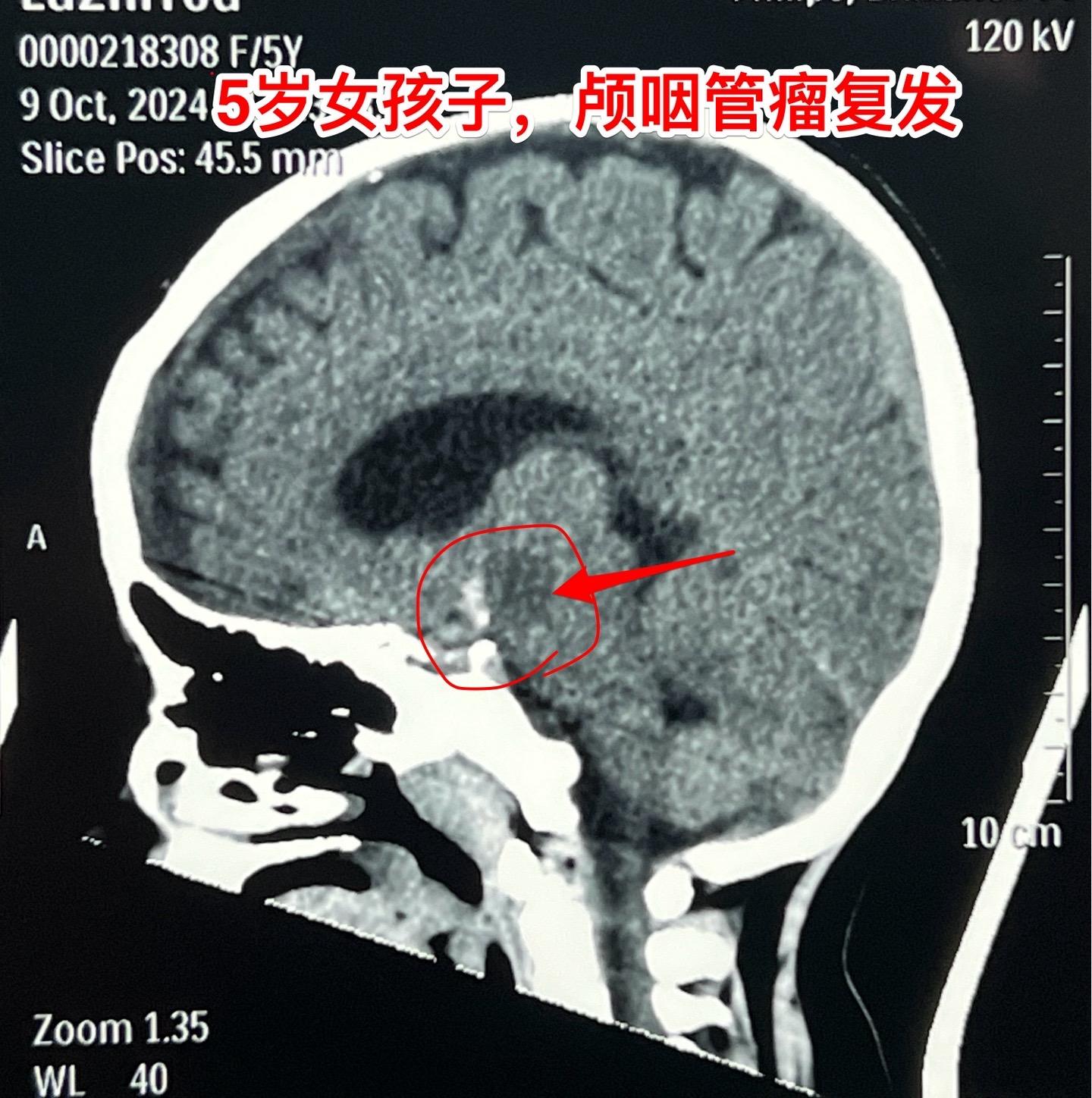 复发颅咽管瘤的手术难度好判断吗？5岁广州的女孩子，颅咽管瘤复发了。第一...