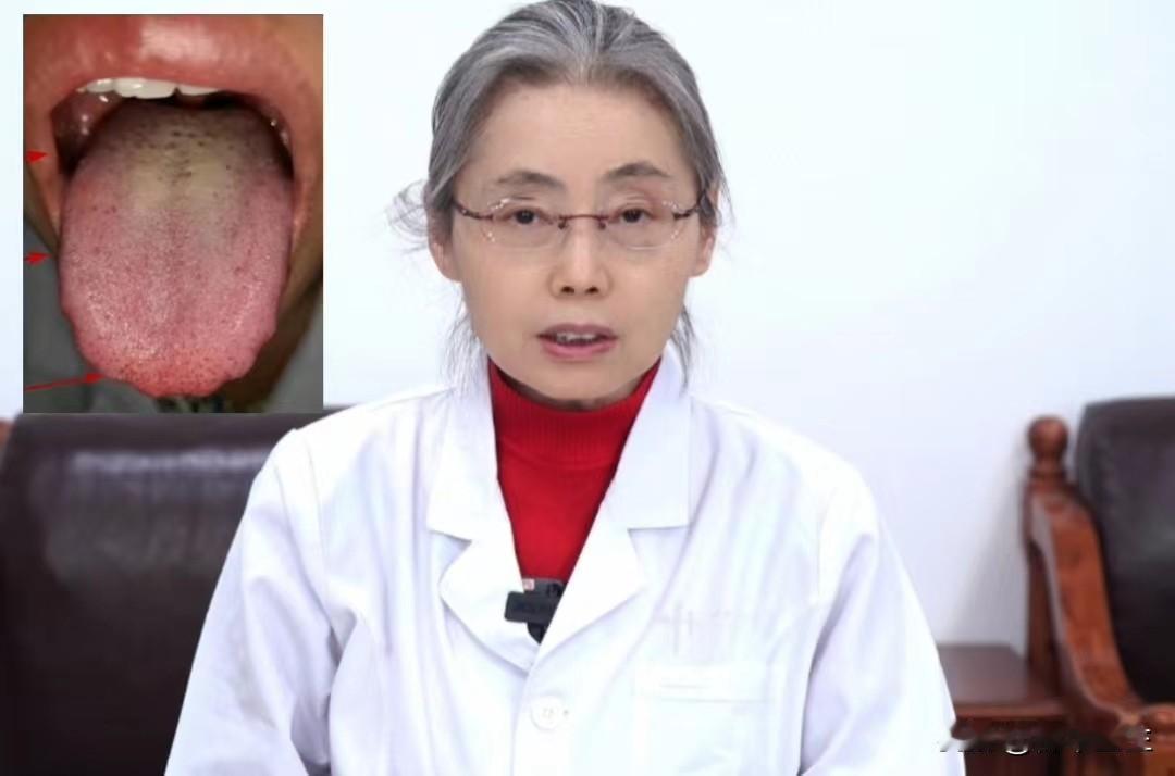 出现这个舌象，不管男女要注意了，尤其是男同志！

这是一位粉丝朋友的舌象。

首