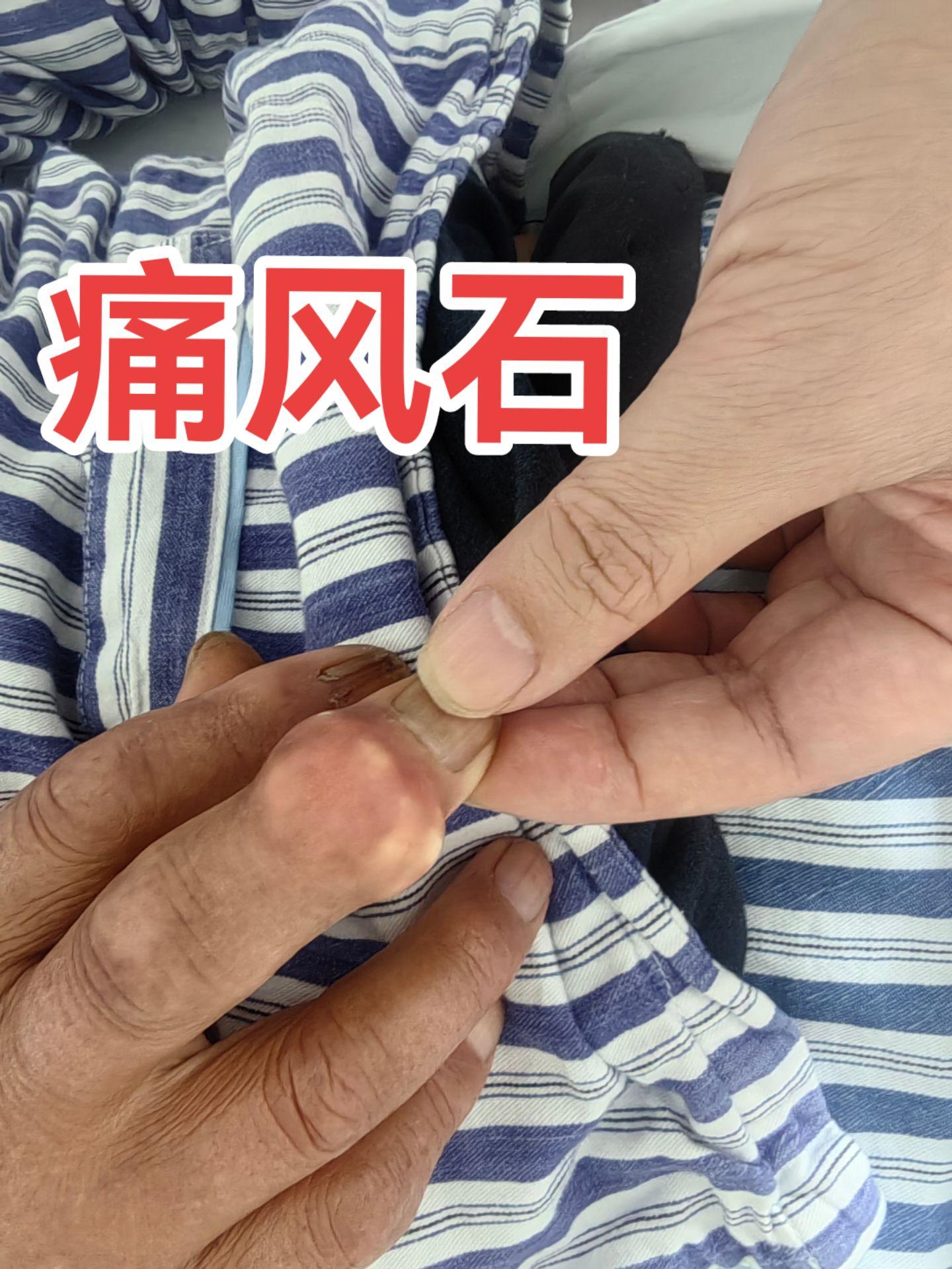 痛风石，药物治疗不会消退，只能手术治疗了。