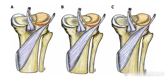 盘状半月板  这是一种半月板的先天发育问题，之前也给大家讲过，因为盘状半月板形状