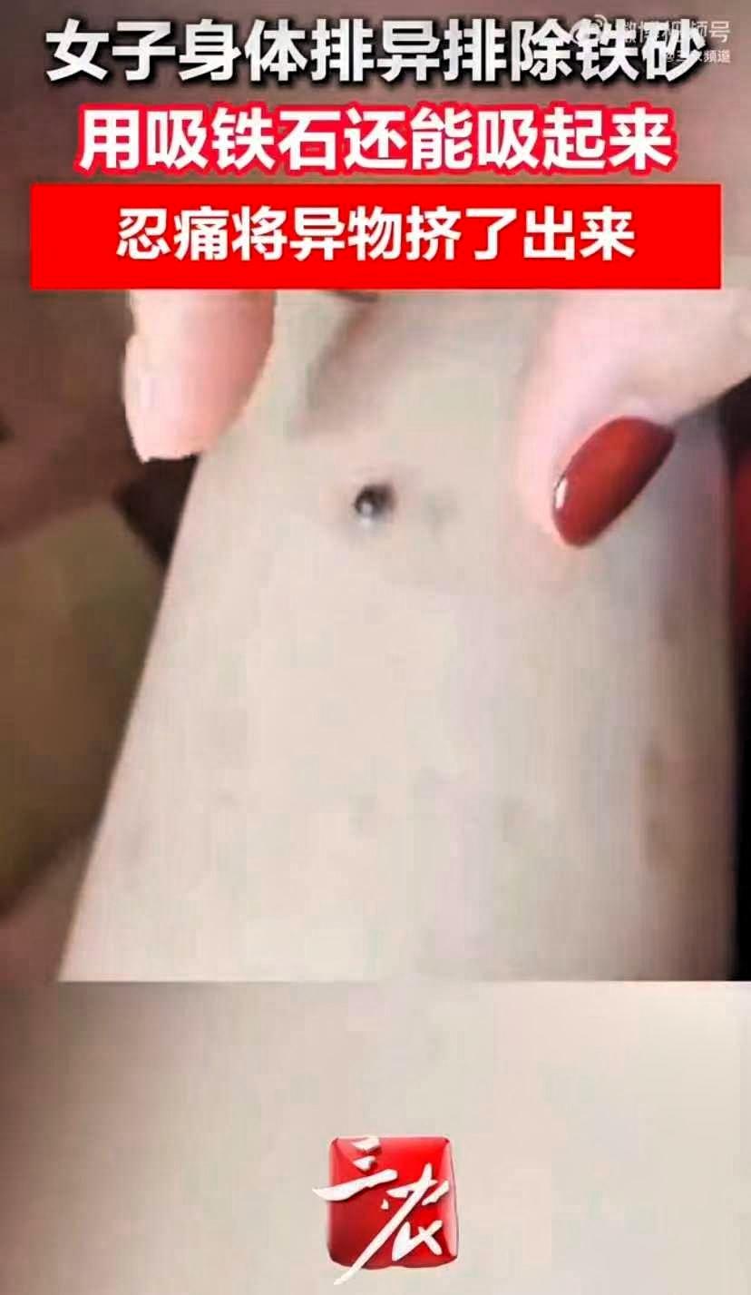 四川一女子30年前被散弹击中，铁砂残留体内。受当时条件所限，没能彻底清理干净，这