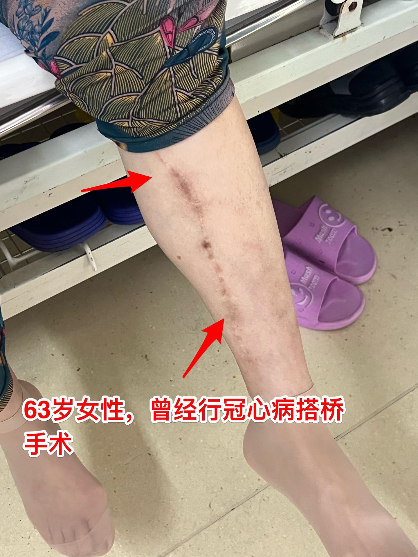 患冠心病、脑梗塞后又发现脑肿瘤。63岁随州女性，之前曾经患冠心病，作过...